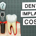 How Much Do Dental Implants Cost In 2025?