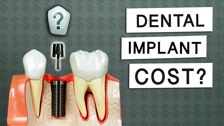 How Much Do Dental Implants Cost In